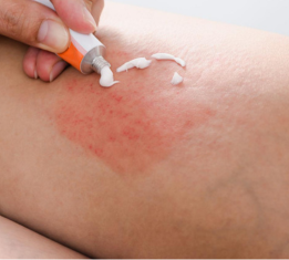 Infected insect bites support